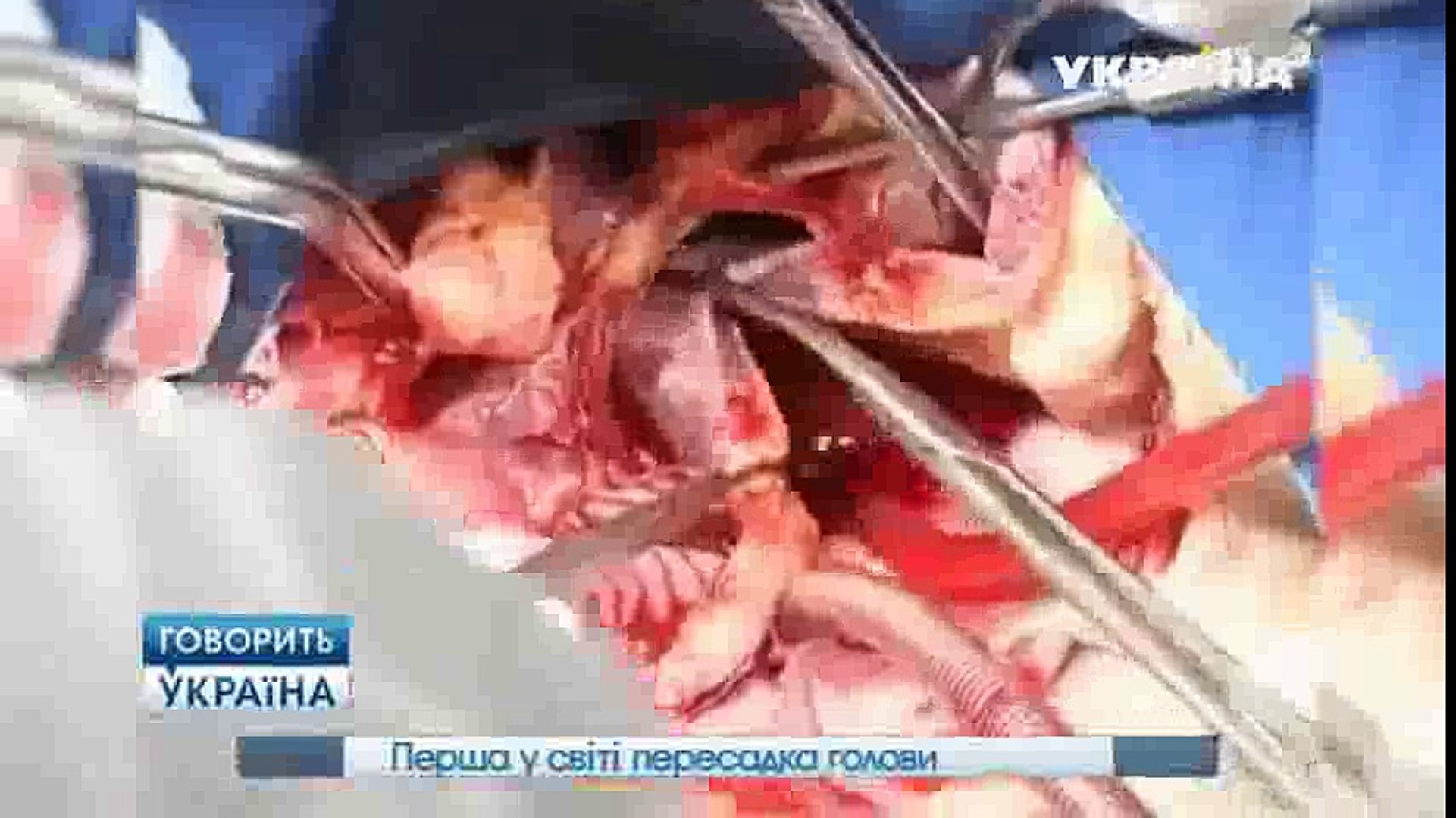 Эксперименты с пересадкой органов | Говорить Україна