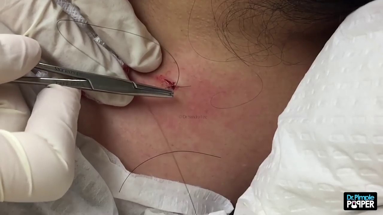 Această femeie avea pe gât un COȘ de trei ani. Când a ajuns la medic, acesta și-a pus mâinile-n cap când a văzut ce are.