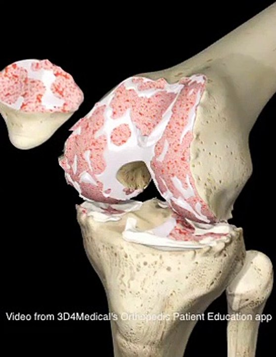 Total Knee Replacement