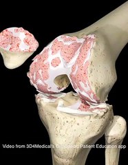 Total Knee Replacement