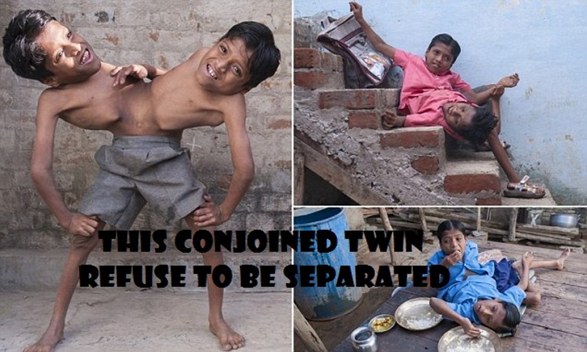 Conjoined TWINS, live life together.