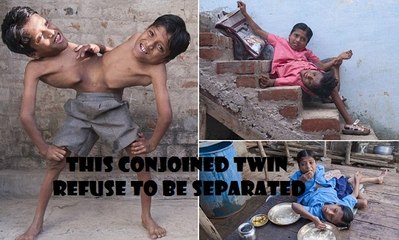 Conjoined TWINS, live life together.