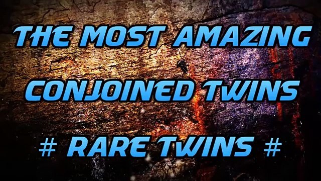 5 Most amazing conjoined twins # RARE TWINS