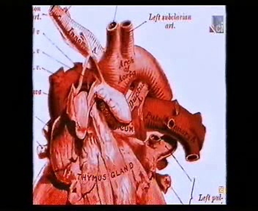 Aneurisma esplenico: Autopsia forense