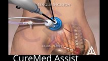 Single Incision Laparoscopic Colectomy utilizing SILS port 3D Medical Animation – CureMed Assist – Medical Tourism Company