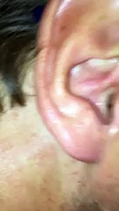 Il ne s'imaginait sûrement pas avoir une telle chose dans l'oreille