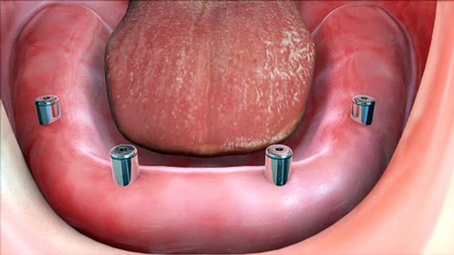 Implant Supported Dentures | Phan-tastic Smiles