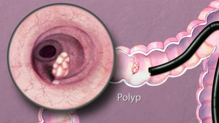 The Importance of Good Bowel Preparation During Colonoscopy – CureMed Assist – Medical Tourism Company