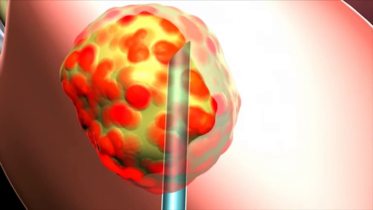 The importance of patients supporting prostate cancer research at CureMed Assist – Medical Tourism Company