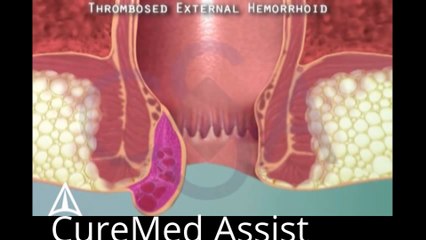 Thrombosed External Hemorrhoid 3D Medical Animation – CureMed Assist – Medical Tourism Company