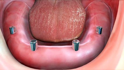 Dental implants procedure video