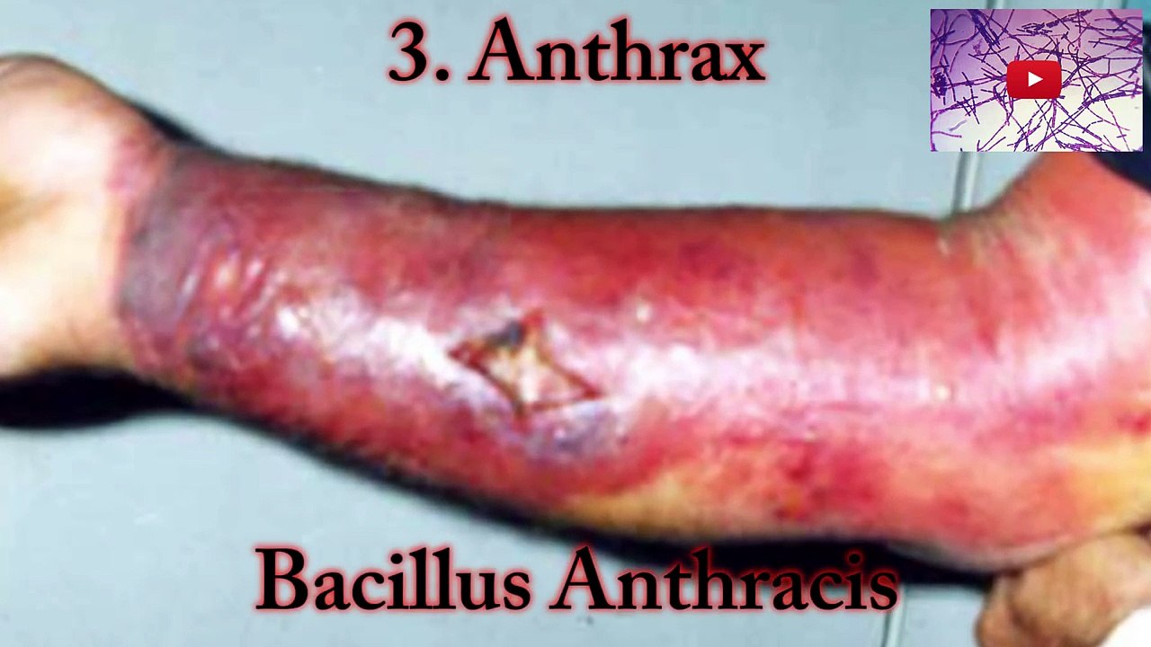 Top 5 Most Dangerous Germs and Viruses