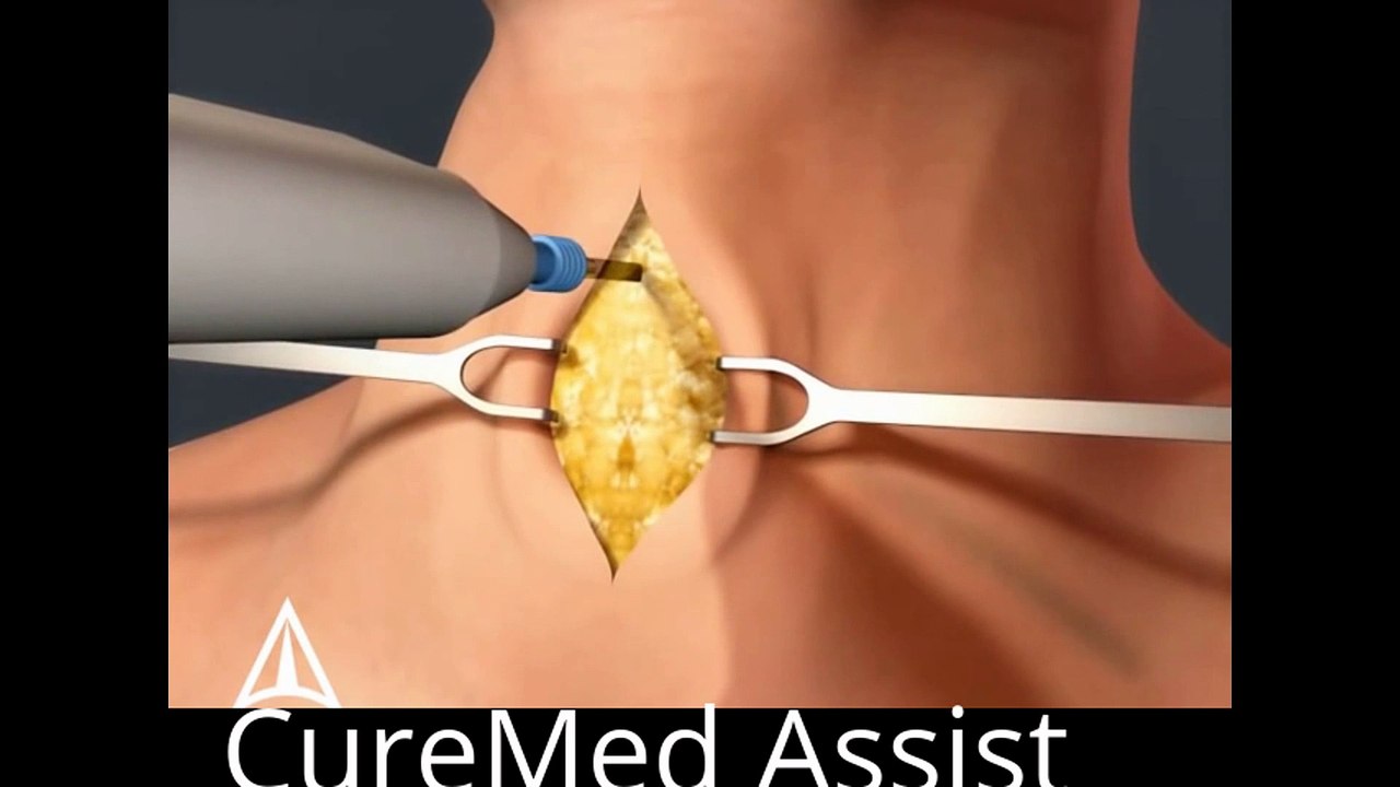 Tracheotomy 3D Medical Animation – CureMed Assist – Medical Tourism Company
