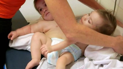 Two-year-old conjoined twins separated by surgeons in US