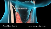 Surgical Techniques Of Robotic Transaxillary Thyroidectomy – CureMed Assist – Medical Tourism Company