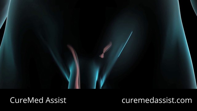 Symptoms And Treatments Of Testicular Cancer – CureMed Assist – Medical Tourism Company