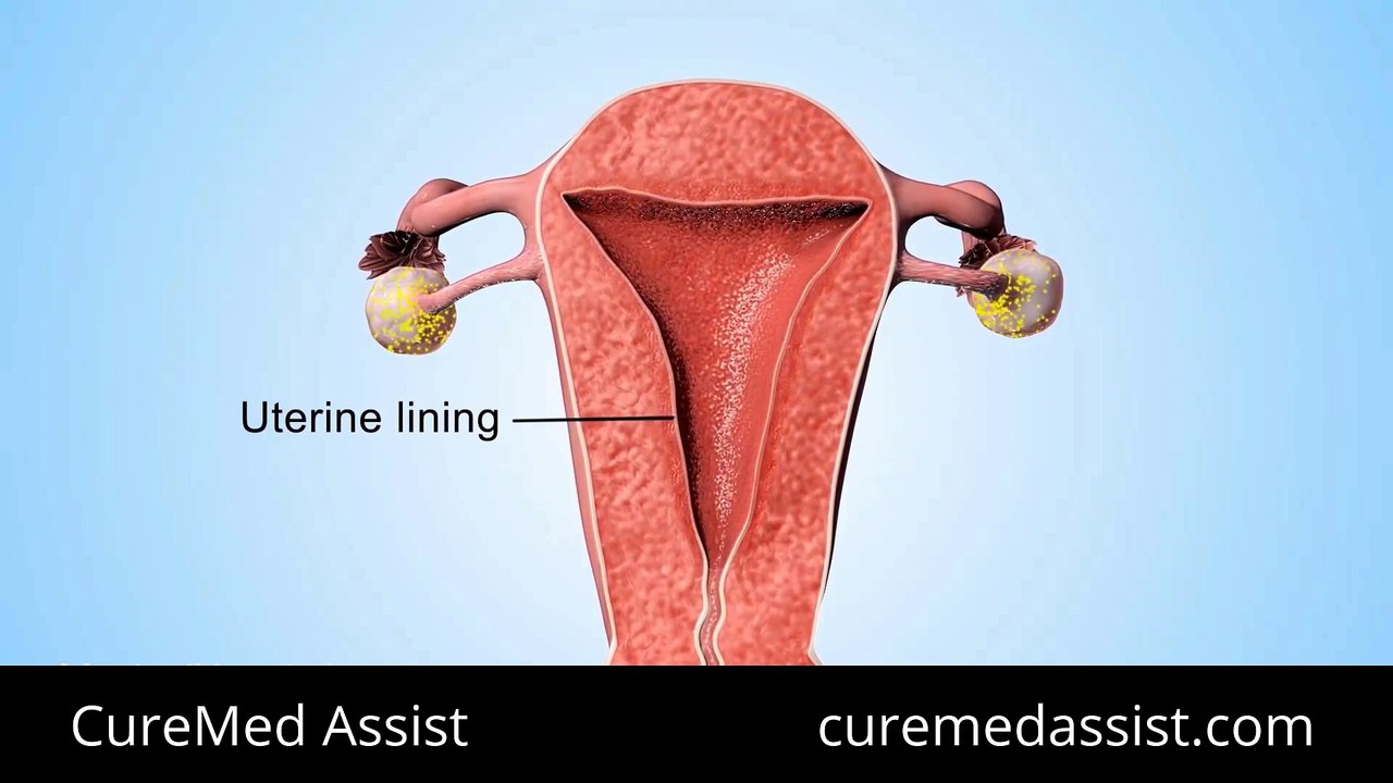 Take Progestin To Prevent Pregnancy – CureMed Assist – Medical Tourism Company