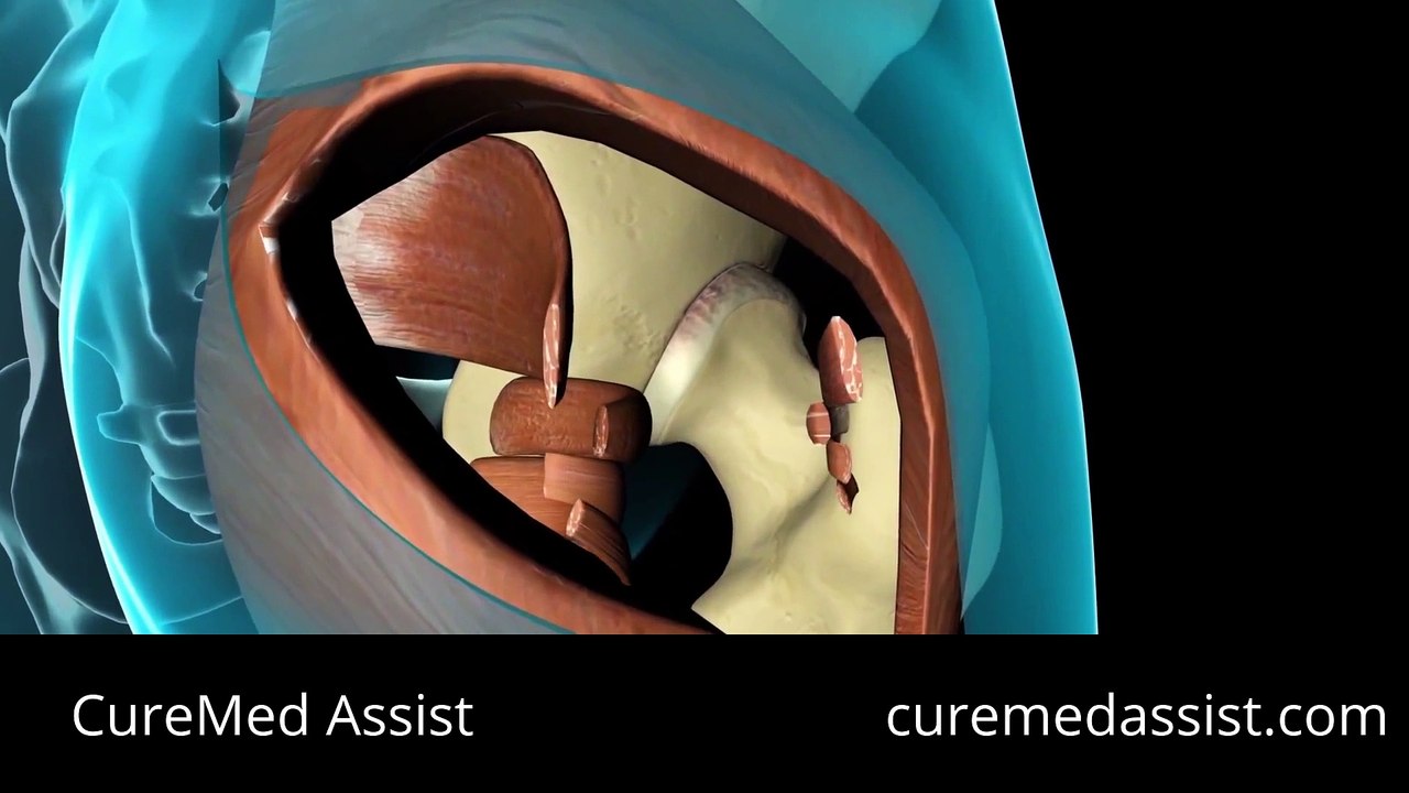 Total Hip Replacement Surgical Procedure – CureMed Assist – Medical Tourism Company