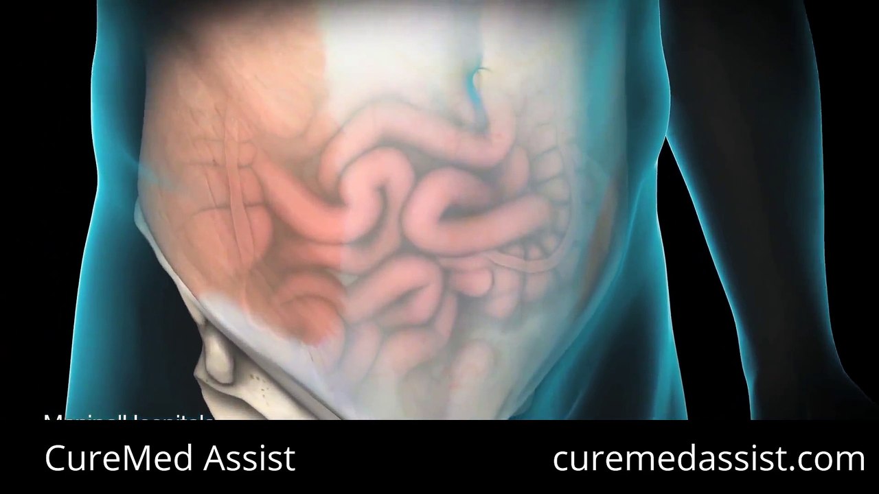 Totally Extraperitoneal Laparoscopic Inguinal Hernia Repair – CureMed Assist – Medical Tourism Company