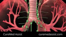 Treatments For Lung Cancer – CureMed Assist – Medical Tourism Company