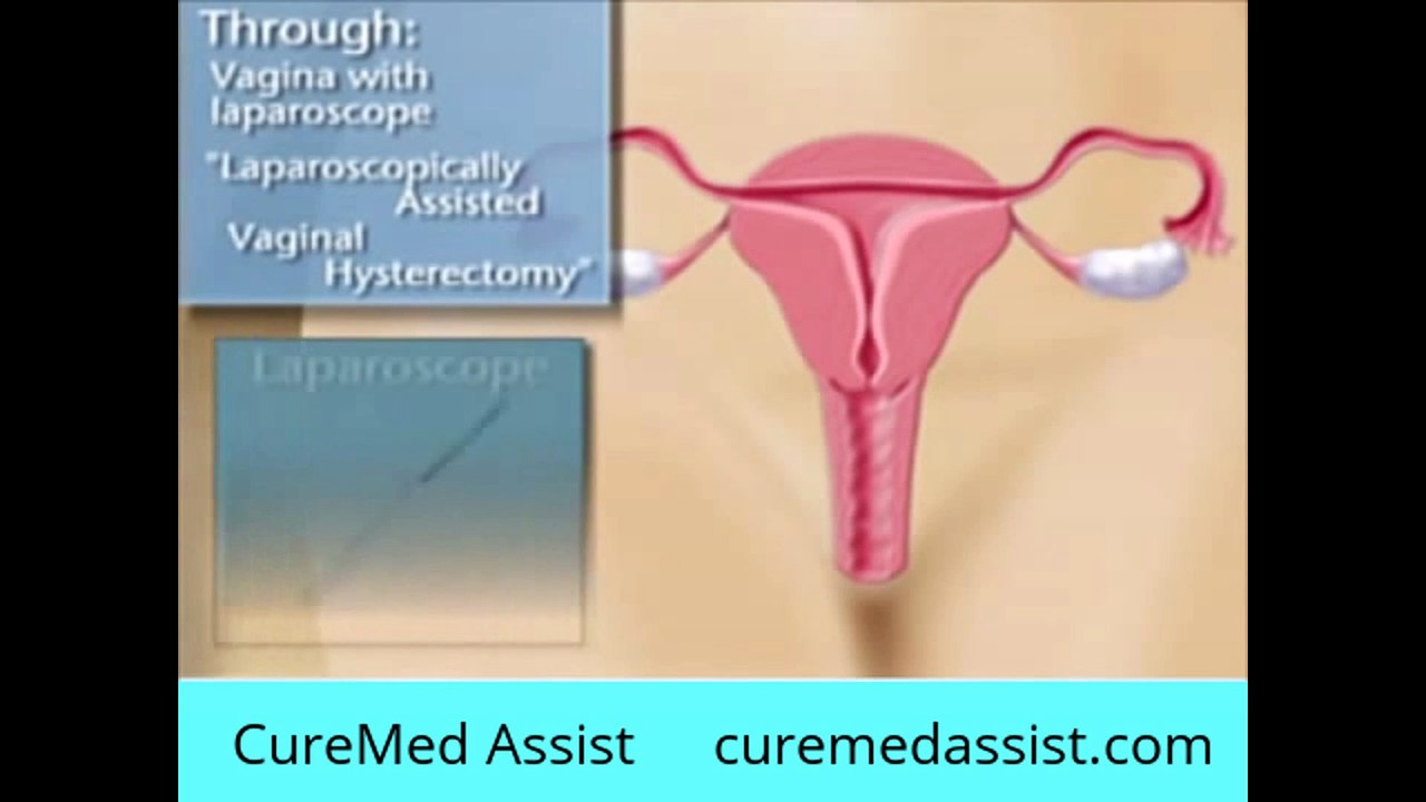 Types of Hysterectomies – CureMed Assist – Medical Tourism Company