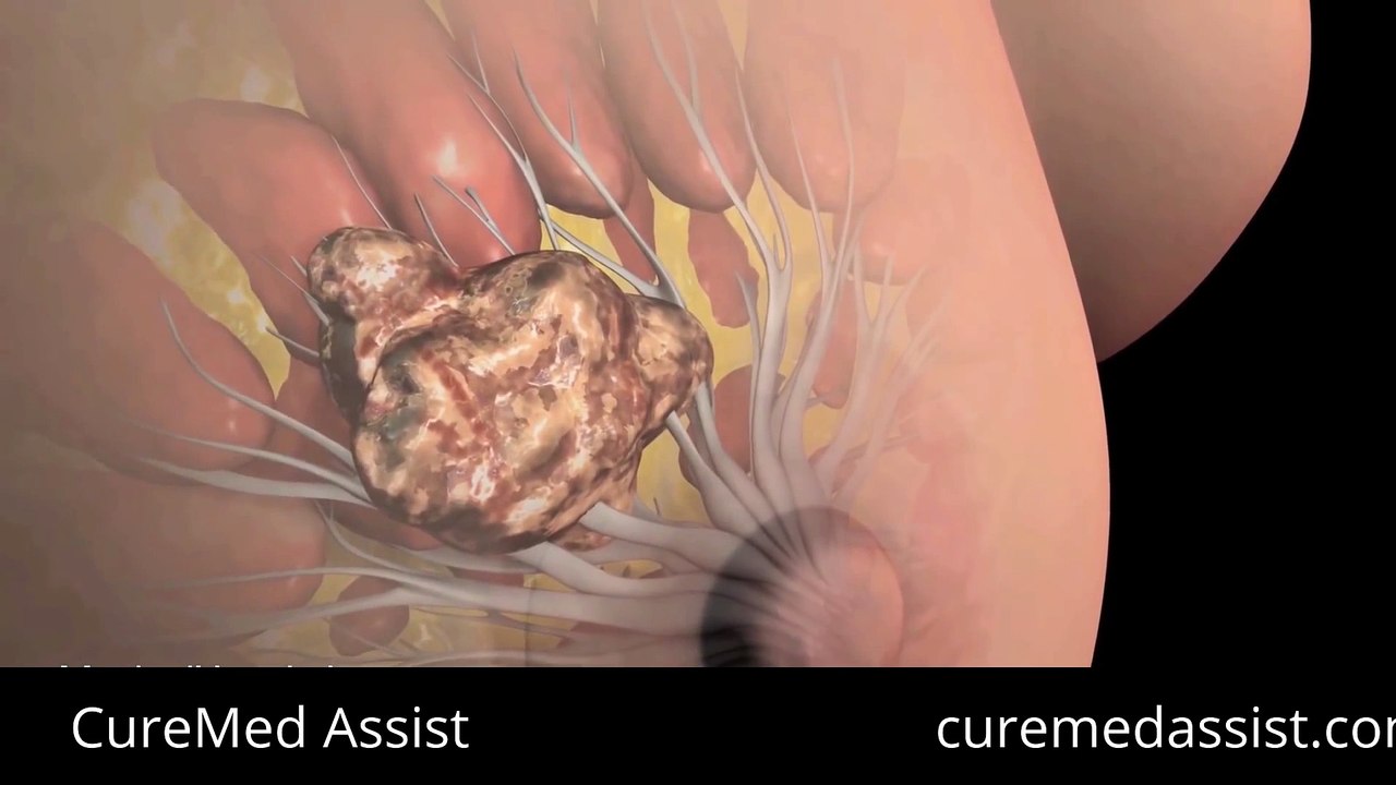 Understand The Symptoms Of Breast Cancer – CureMed Assist – Medical Tourism Company