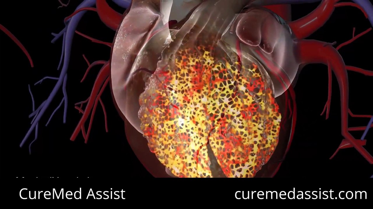 Understanding the Pacemaker And Heart's Electrical System – CureMed Assist – Medical Tourism Company