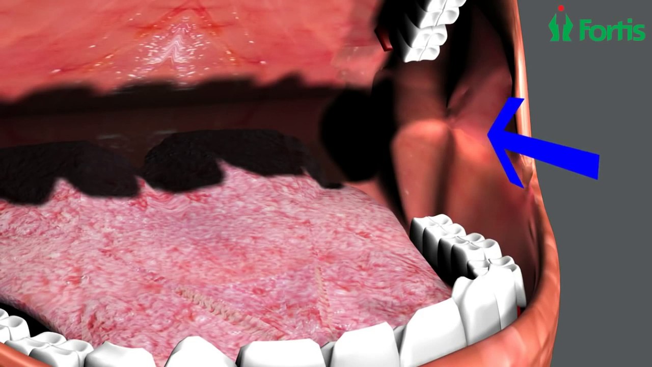 Urethral Stricture Buccal Mucosal Graft Process – CureMed Assist – Medical Tourism Company