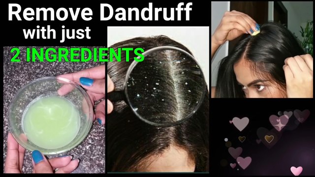 Magical Home Remedy to Remove DANDRUFF at home//Dandruff treatment/How to get rid of dandruff