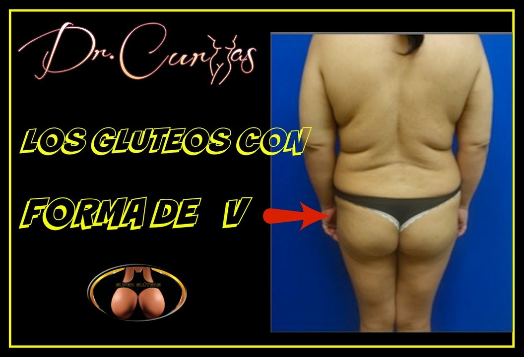 Los glúteos con forma de v