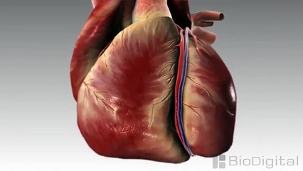 3D Medical Animation - What is a Heart Attack.