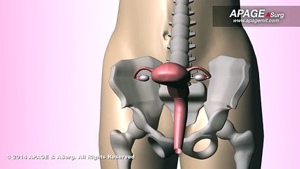 Animation of Laparoscopically Assisted Vaginal Hysterectomy (LAVH)