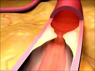 Heart attack in 3d animation