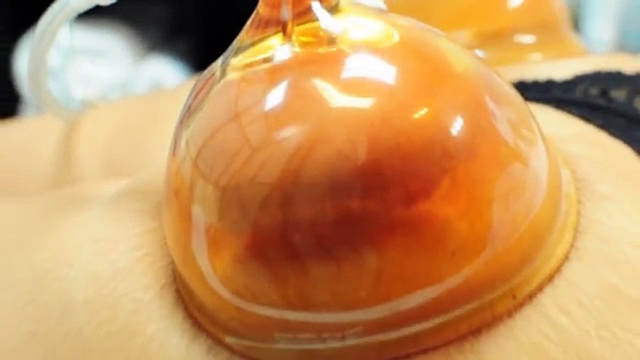 Non Surgical Gluteus Lifting and Firming Treatment