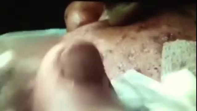 Oil filaments cleaning, cleaning of oil glands, acne facial cleansing, oil glands in the cheeks