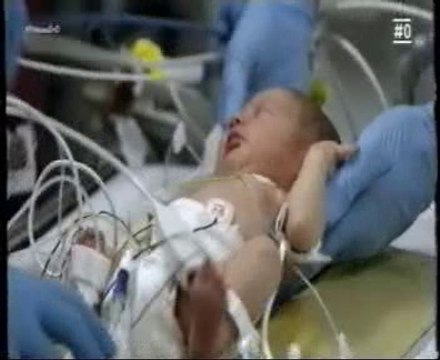 Cardiopatia congenita: Cirugia postnatal