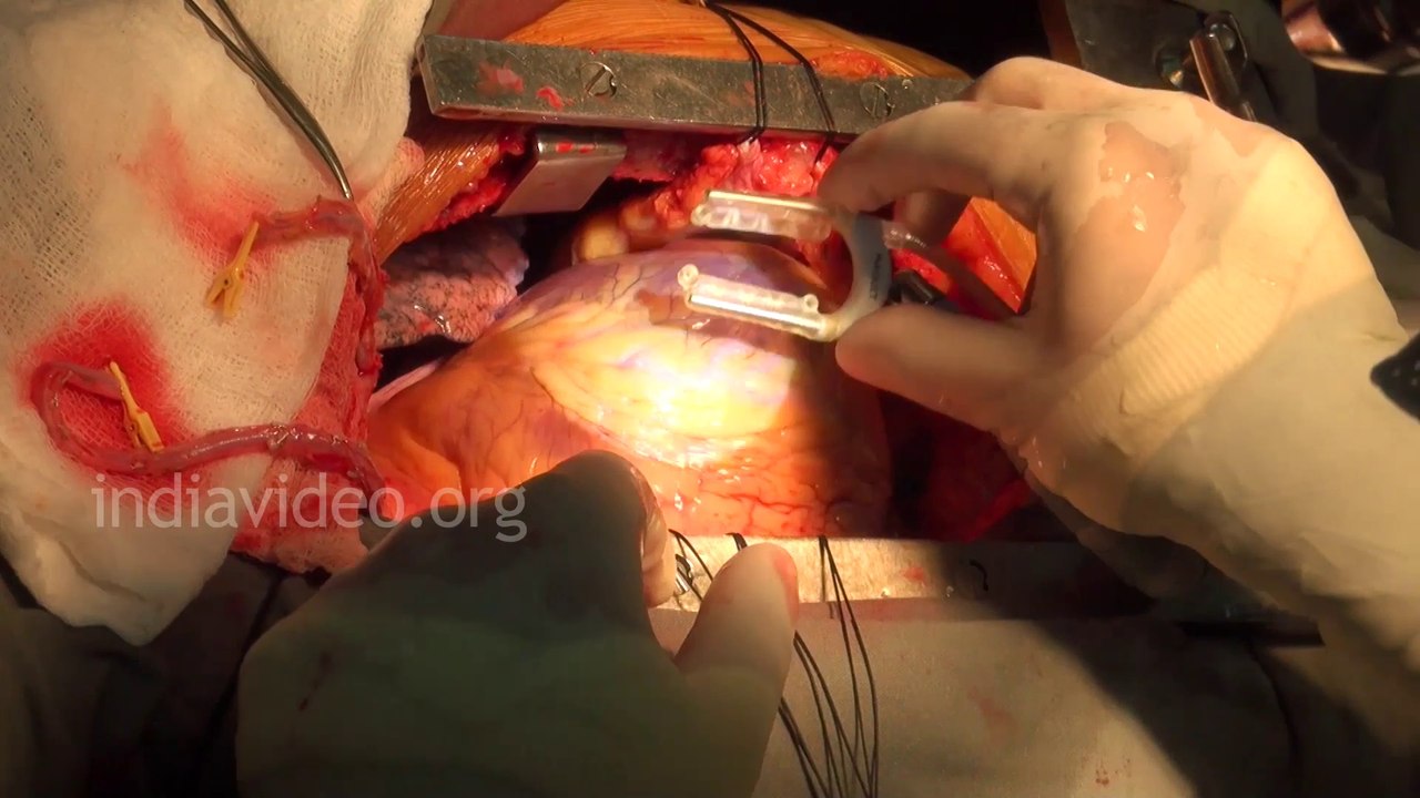 Open Heart Surgery LIve