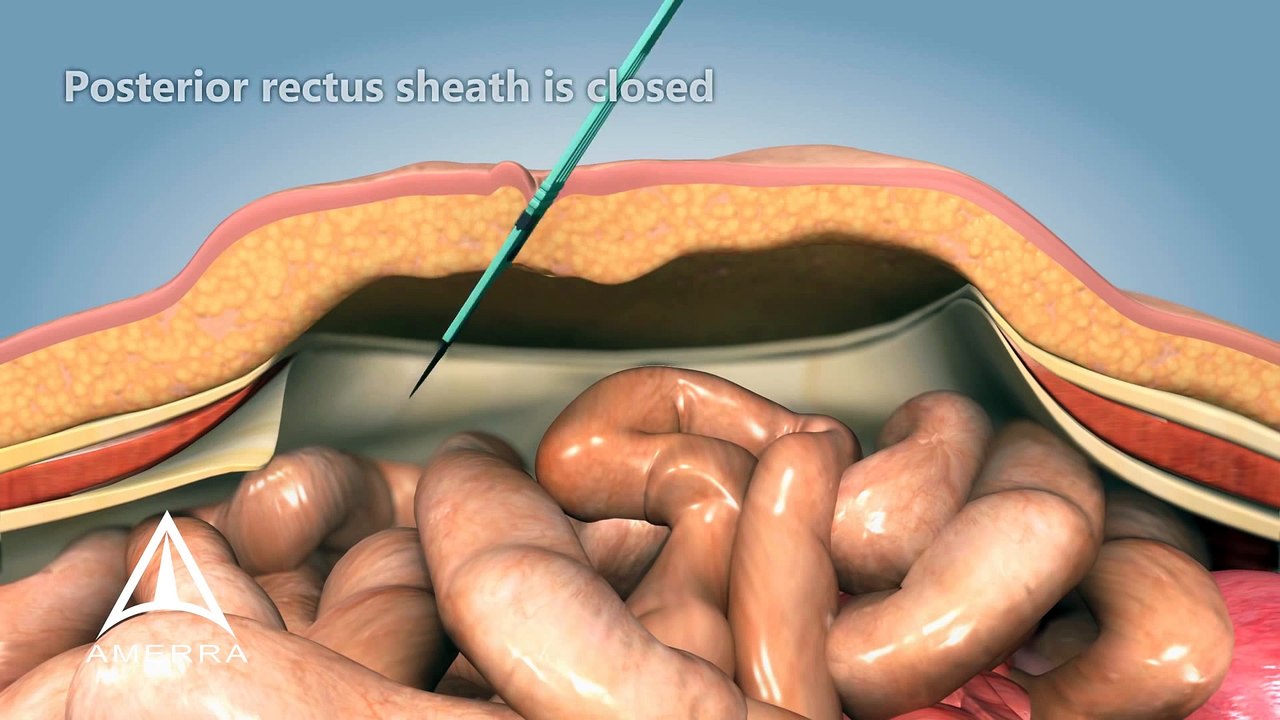 Ventral Hernia Repair 3D Medical Animation – CureMed Assist – Medical Tourism Company