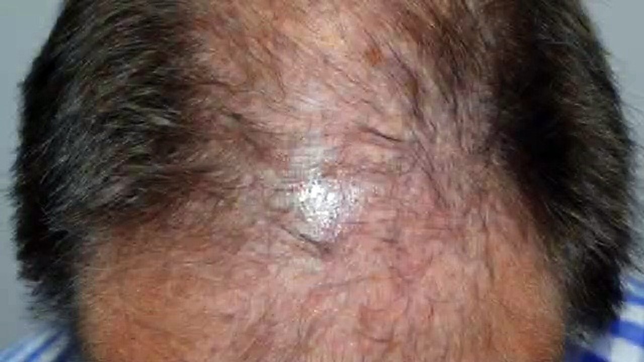 CLINICAS CETA CAPITAL www.injertodepelo.es