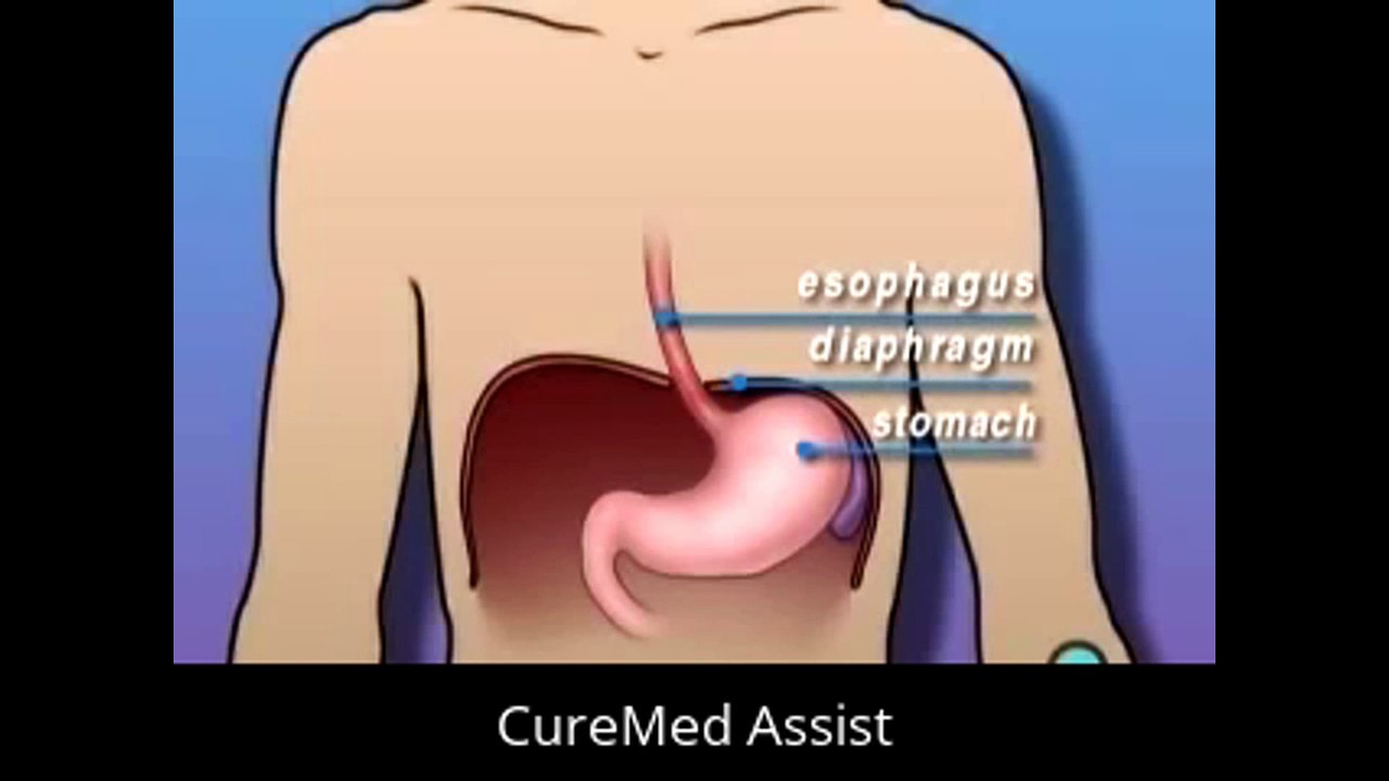Patient Education Minimal Anti Reflux Laparoscopy – CureMed Assist – Medical Tourism Company