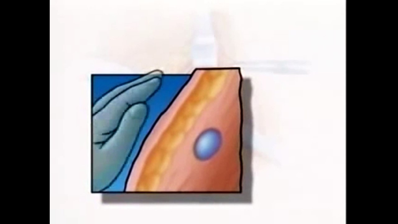 Patient Education Minimal Biopsy General Surgery – CureMed Assist – Medical Tourism Company