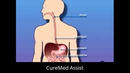 Patient Education Minimal GI Endoscopy Upper GI – CureMed Assist – Medical Tourism Company