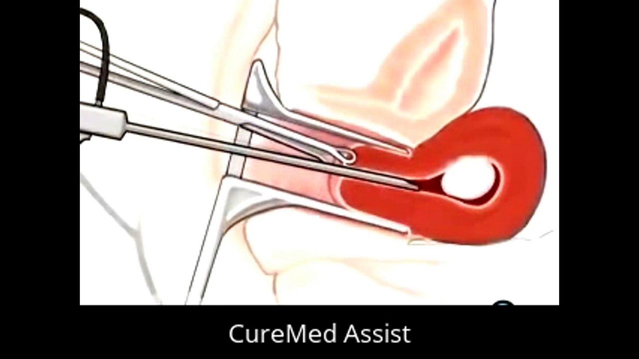 Patient Education Myomectomy Vaginal Fibroid Removal Surgery 2 – CureMed Assist – Medical Tourism Company