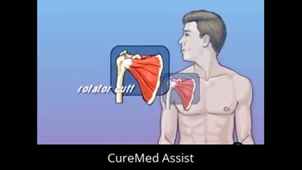 Patient Education Rotator Cuff Repair Open Surgery – CureMed Assist – Medical Tourism Company