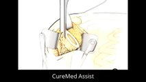 Patient Education Shoulder Replacement Surgery 2 – CureMed Assist – Medical Tourism Company