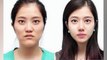 30 Korean Plastic Surgery Before and After Photos