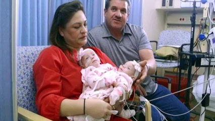 Siamesas latinas sobreviven a delicada cirugía de separación en EE.UU.
