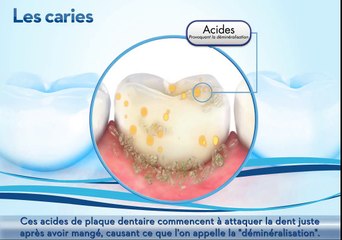 Caries dentaires - Informations, Conseils & Traitements - Oral-B