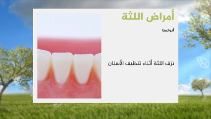 هذا الصباح-علاقة أمراض اللثة بأمراض القلب