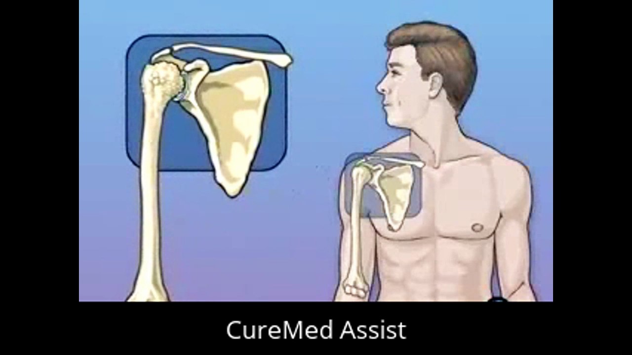 Patient Education Shoulder Replacement Surgery – CureMed Assist – Medical Tourism Company